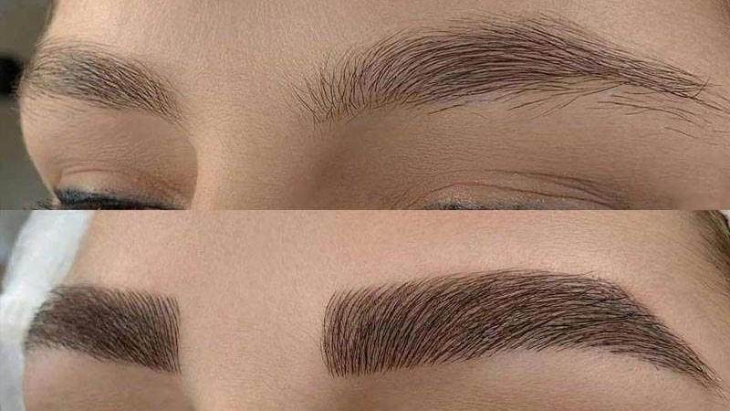 میکروبلیدینگ حسینی