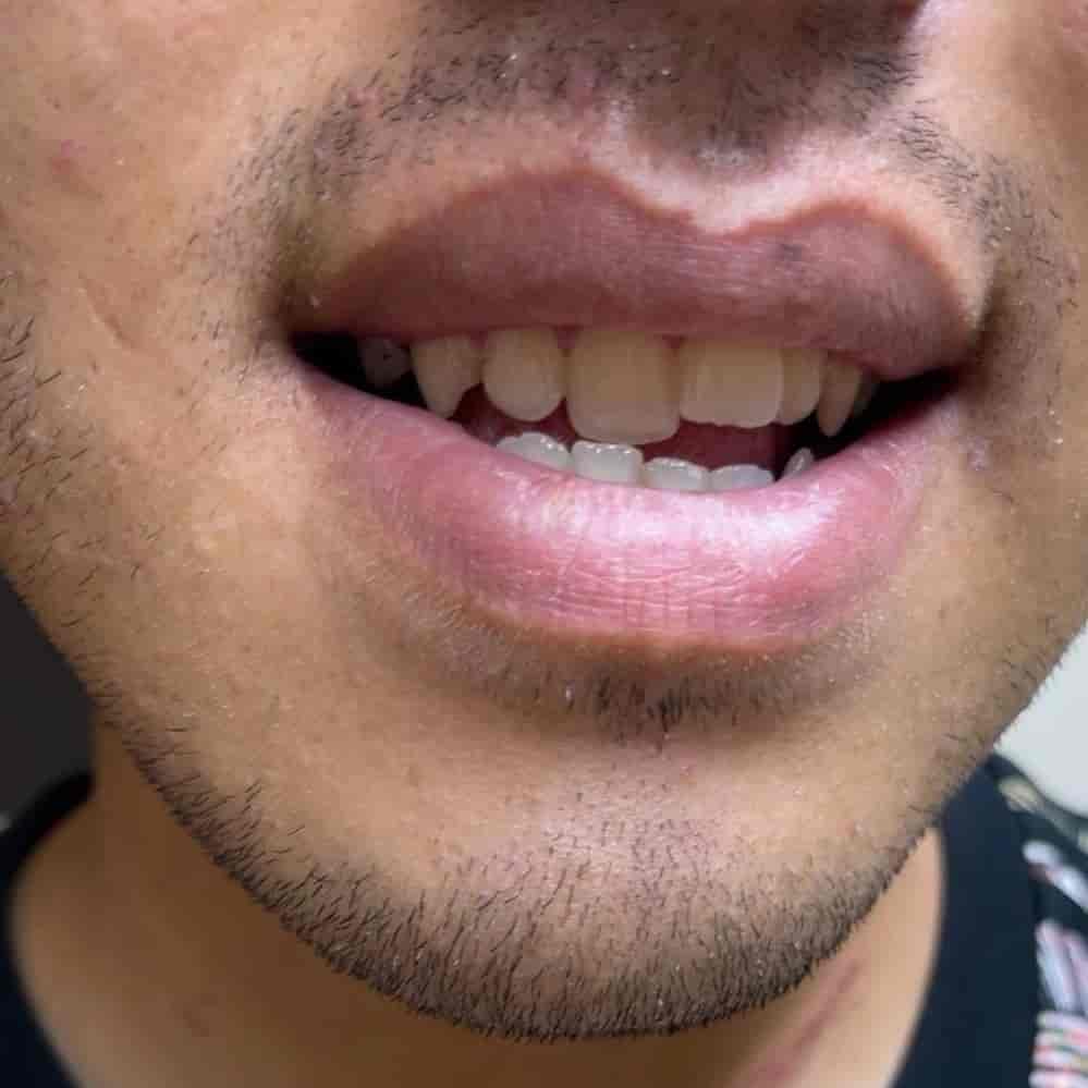 انجام ۱۶ واحد کامپوزیت
