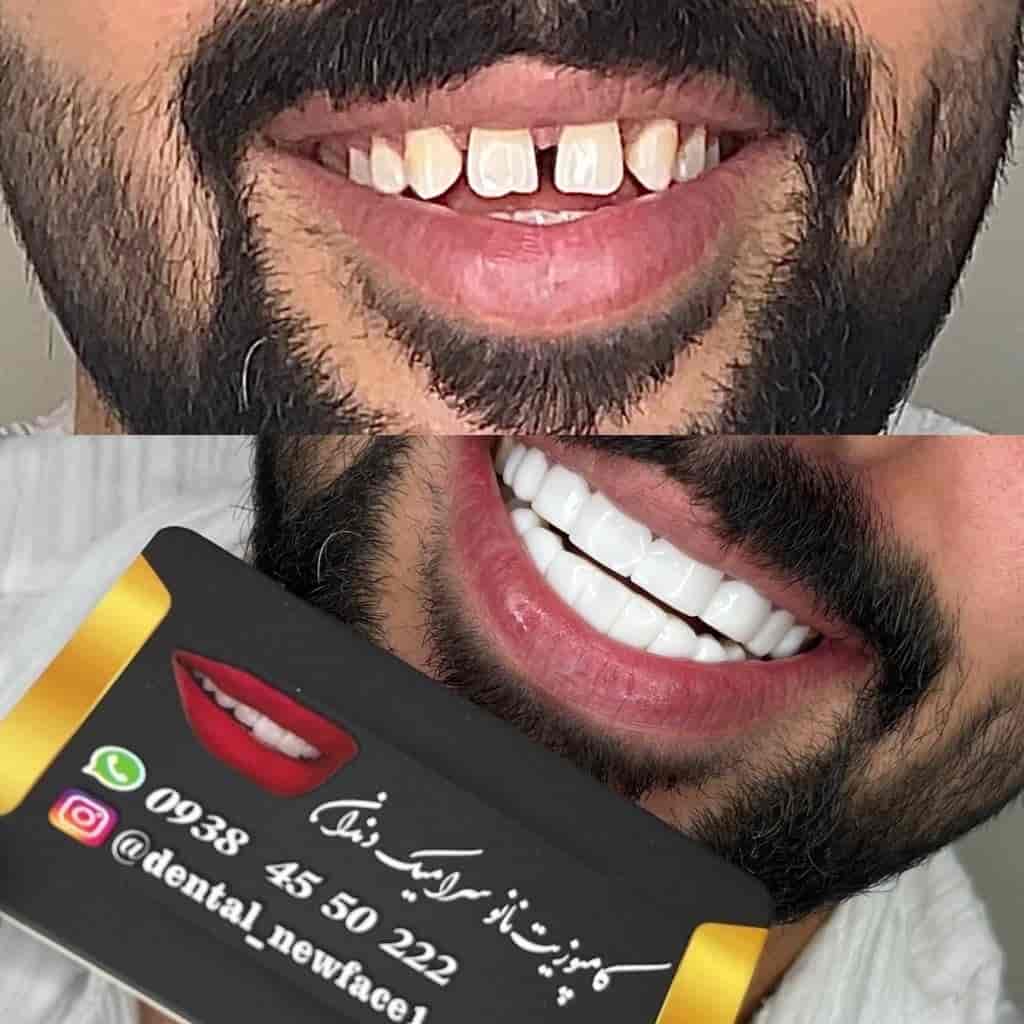 کامپوزیت نانوسرامیک برند سوئیسی