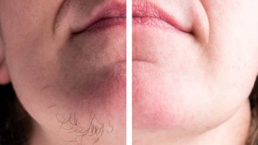 تعداد جلسات لیزر موهای زائد برای نتیجه دائمی، راهنمای کامل مشهد