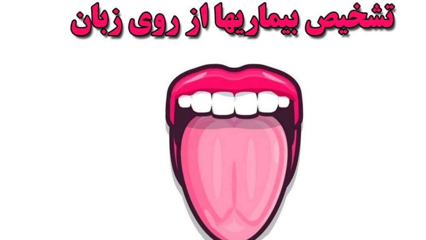 تشخیص بیماری از زبان