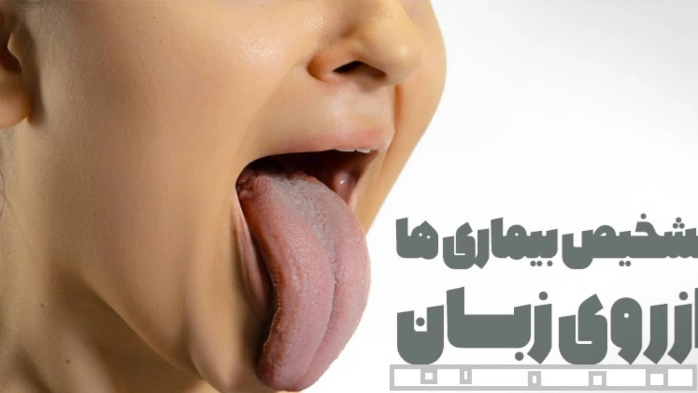 تشخیص بیماری از زبان